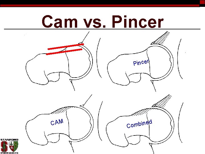 Cam vs. Pincer CAM d ine Comb 