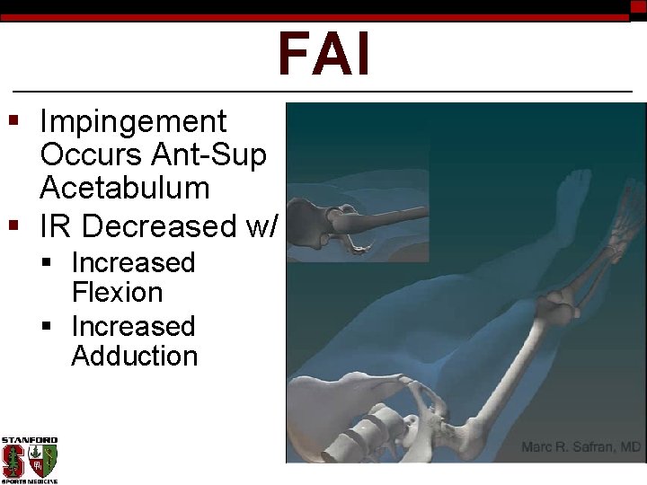 FAI § Impingement Occurs Ant-Sup Acetabulum § IR Decreased w/ § Increased Flexion §