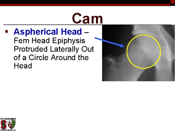 Cam § Aspherical Head – Fem Head Epiphysis Protruded Laterally Out of a Circle
