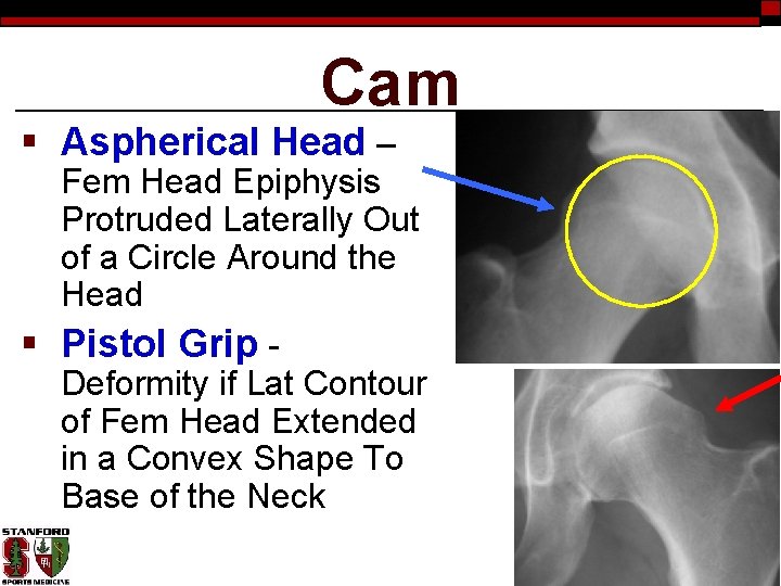 Cam § Aspherical Head – Fem Head Epiphysis Protruded Laterally Out of a Circle