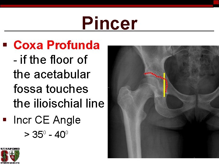 Pincer § Coxa Profunda - if the floor of the acetabular fossa touches the