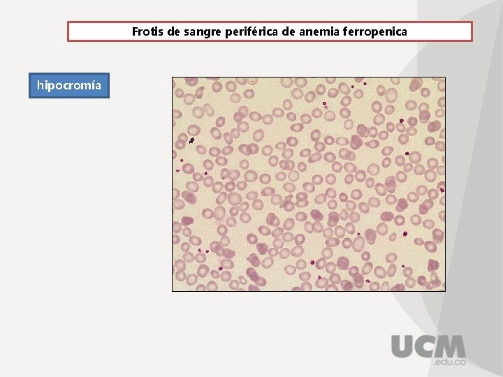 Frotis de sangre periférica de anemia ferropenica hipocromía 