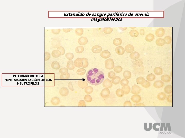 Extendido de sangre periférica de anemia megaloblastica PLEOCARIOCITOS o HIPERSEGMENTACIÓN DE LOS NEUTROFILOS 