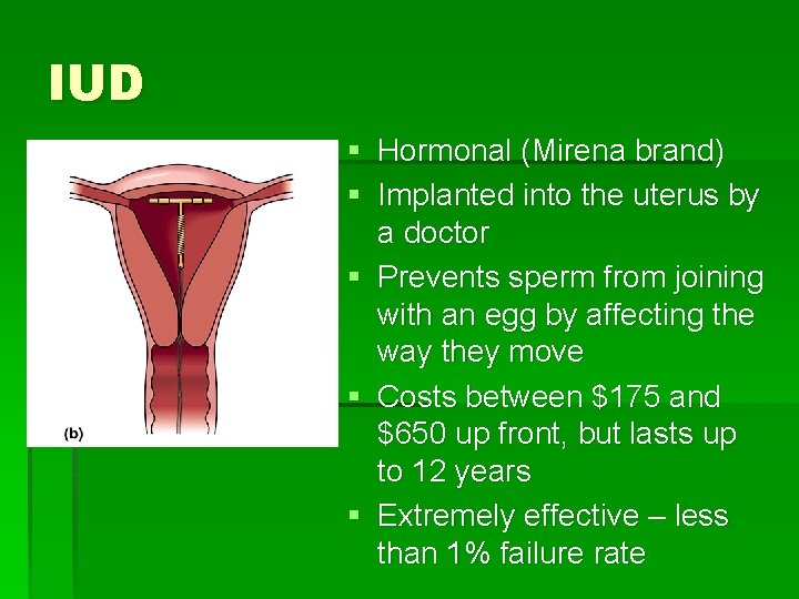 IUD § Hormonal (Mirena brand) § Implanted into the uterus by a doctor §