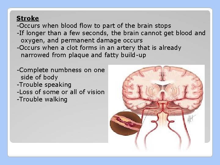 Stroke -Occurs when blood flow to part of the brain stops -If longer than