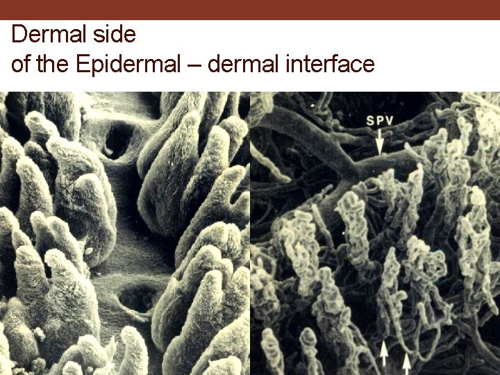 Dermal side of the Epidermal – dermal interface 