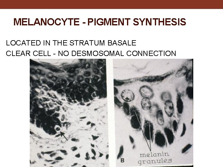 MELANOCYTE - PIGMENT SYNTHESIS LOCATED IN THE STRATUM BASALE CLEAR CELL - NO DESMOSOMAL