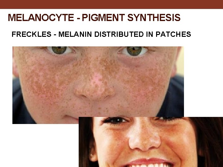 MELANOCYTE - PIGMENT SYNTHESIS FRECKLES - MELANIN DISTRIBUTED IN PATCHES 