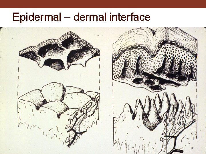 Epidermal – dermal interface 