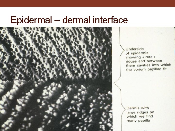 Epidermal – dermal interface 