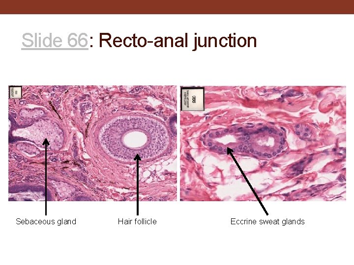 Slide 66: Recto-anal junction Sebaceous gland Hair follicle Eccrine sweat glands 