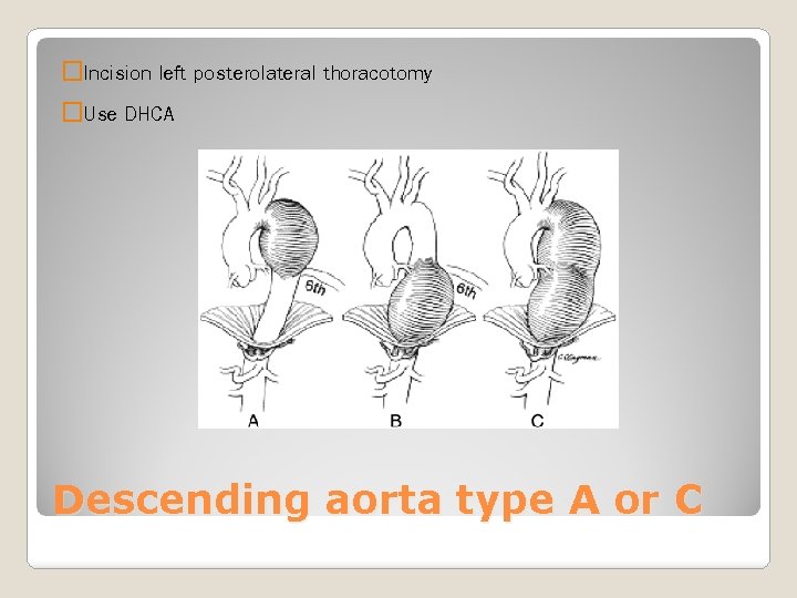�Incision left posterolateral thoracotomy �Use DHCA Descending aorta type A or C 