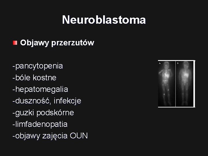 Neuroblastoma Objawy przerzutów -pancytopenia -bóle kostne -hepatomegalia -duszność, infekcje -guzki podskórne -limfadenopatia -objawy zajęcia