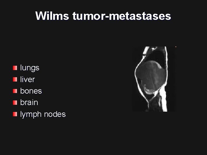 Wilms tumor-metastases lungs liver bones brain lymph nodes 