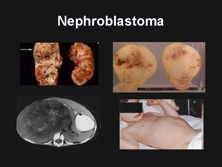 Nephroblastoma 