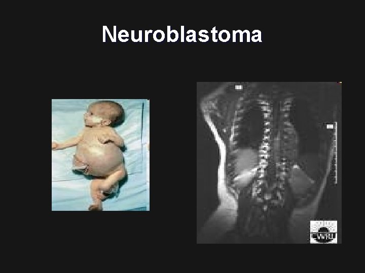 Neuroblastoma 