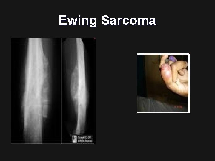 Ewing Sarcoma 