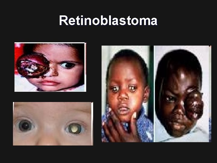 Retinoblastoma 