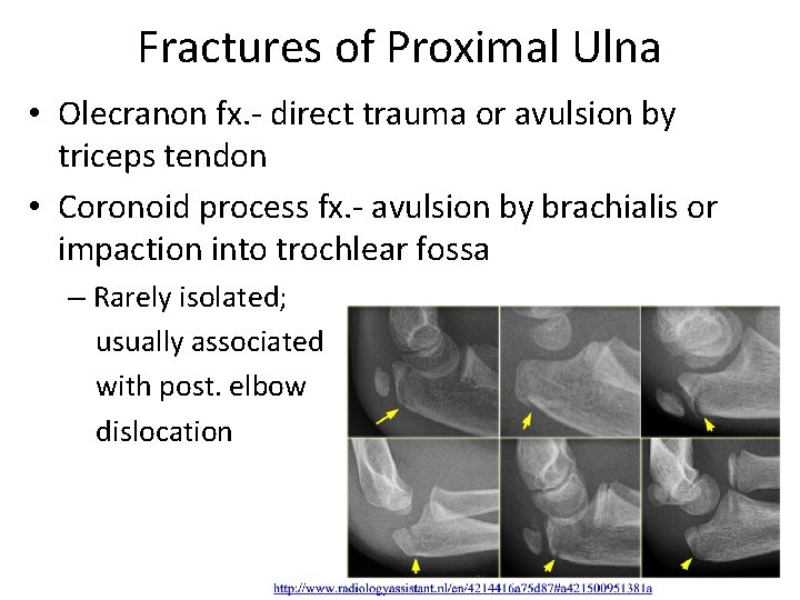 Fractures of Proximal Ulna • Olecranon fx. - direct trauma or avulsion by triceps