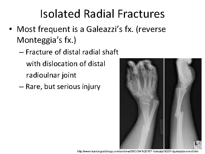 Isolated Radial Fractures • Most frequent is a Galeazzi’s fx. (reverse Monteggia’s fx. )