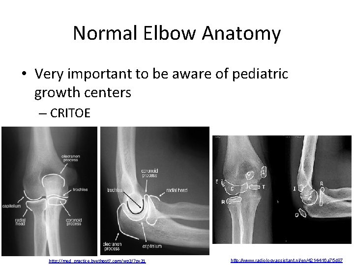 Normal Elbow Anatomy • Very important to be aware of pediatric growth centers –