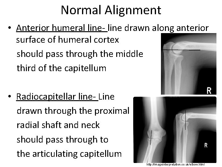 Normal Alignment • Anterior humeral line- line drawn along anterior surface of humeral cortex