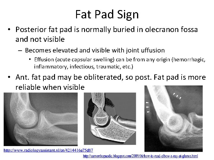 Fat Pad Sign • Posterior fat pad is normally buried in olecranon fossa and