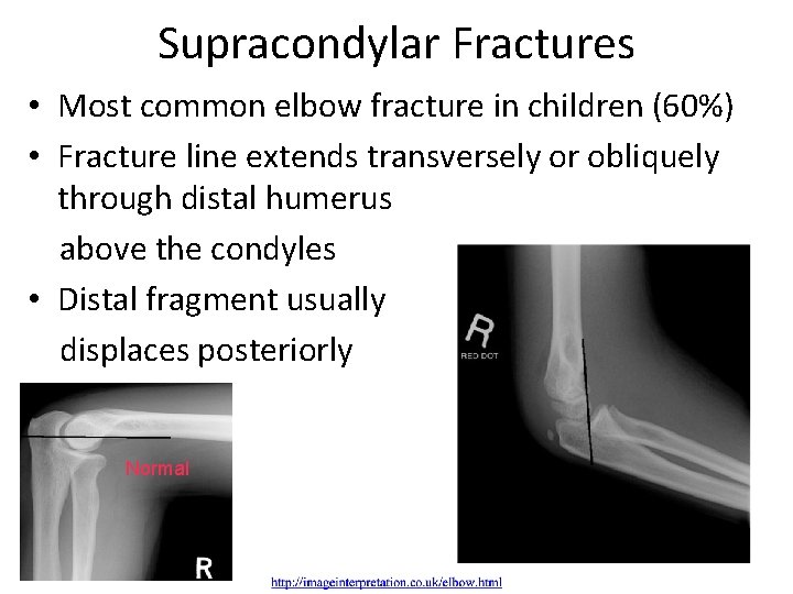 Supracondylar Fractures • Most common elbow fracture in children (60%) • Fracture line extends