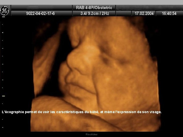 L'écographie permet de voir les caractéristiques du bébé, et même l'expression de son visage. L'écographie permet de voir les caractéristiques du bébé, et même l'expression de son visage.