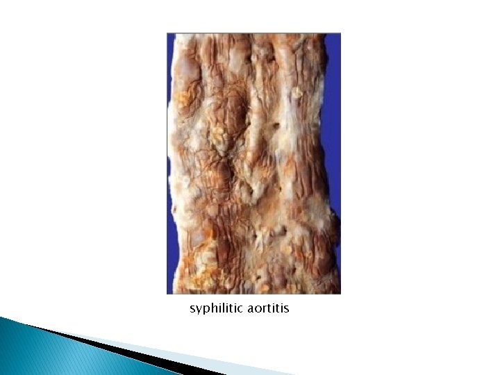 syphilitic aortitis 