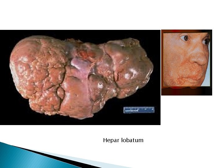 Hepar lobatum 