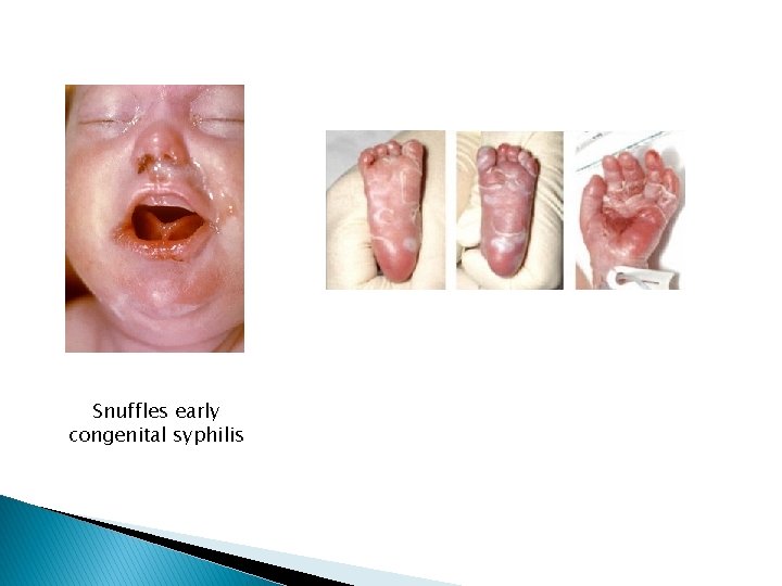 Snuffles early congenital syphilis 