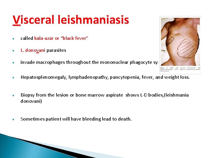 Visceral leishmaniasis called kala-azar or “black fever” L. donovani parasites invade macrophages throughout the