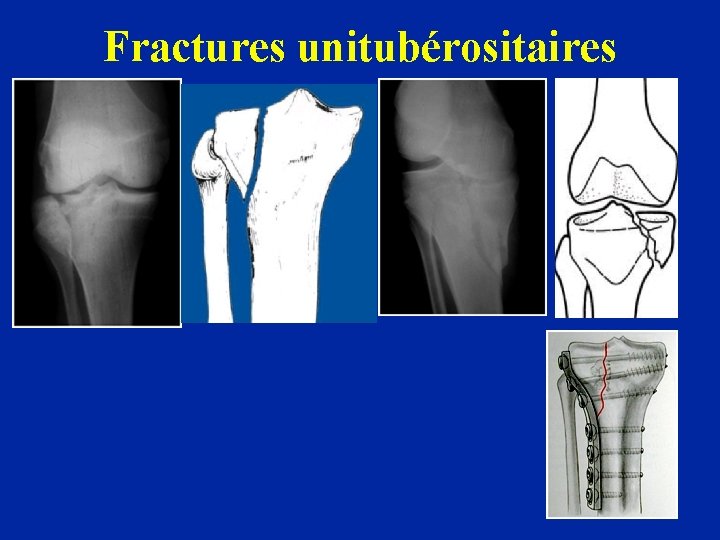 Fractures unitubérositaires 