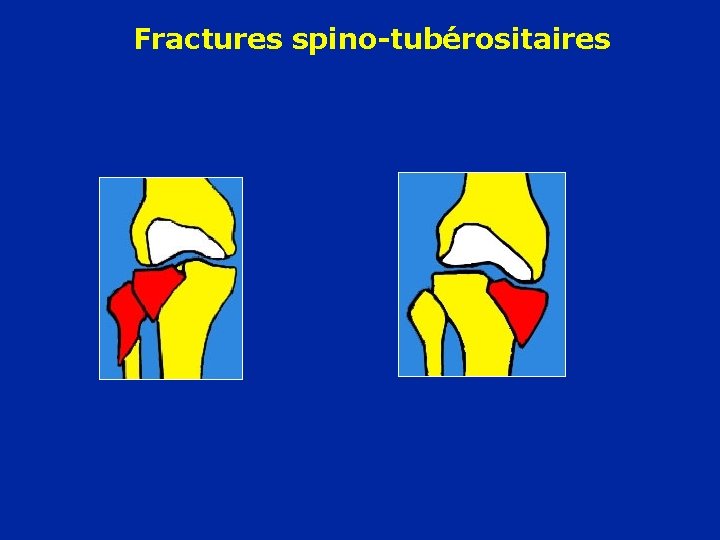 Fractures spino-tubérositaires 