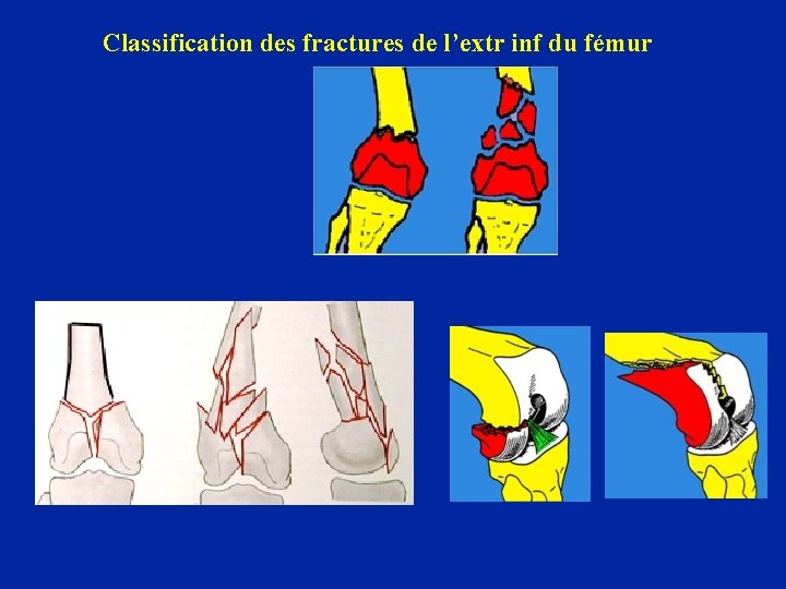 Classification des fractures de l’extr inf du fémur Supra condyliennes : 45% Supra et