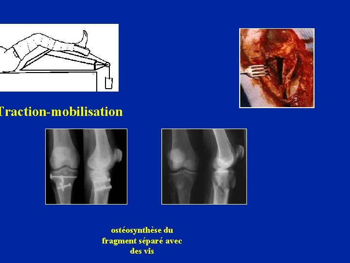 Traction-mobilisation ostéosynthèse du fragment séparé avec des vis 