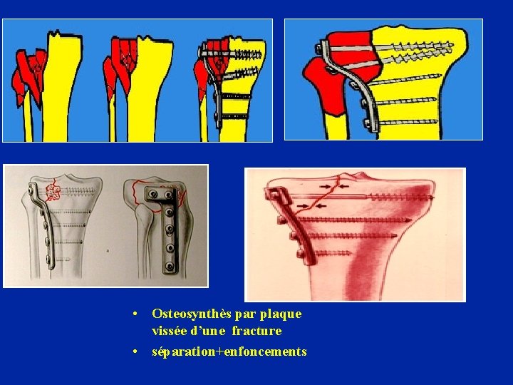  • Osteosynthès par plaque vissée d’une fracture • séparation+enfoncements 