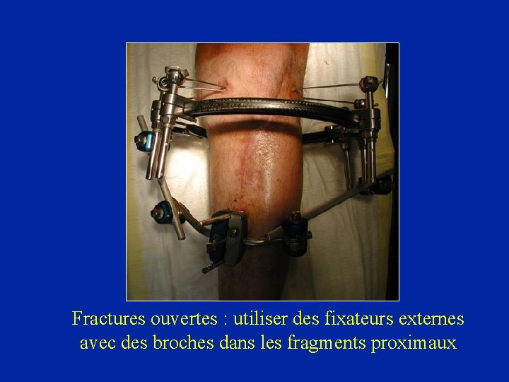 Fractures ouvertes : utiliser des fixateurs externes avec des broches dans les fragments proximaux