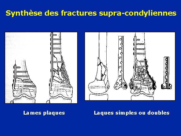 Synthèse des fractures supra-condyliennes Lames plaques Laques simples ou doubles 