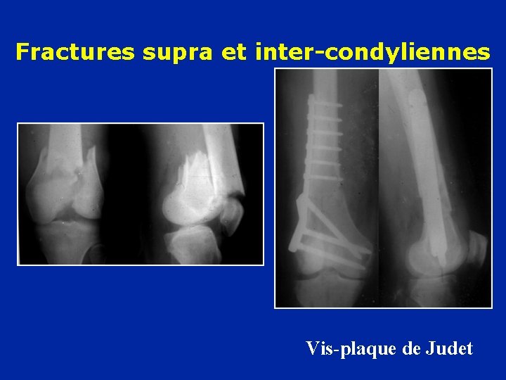 Fractures supra et inter-condyliennes Vis-plaque de Judet 