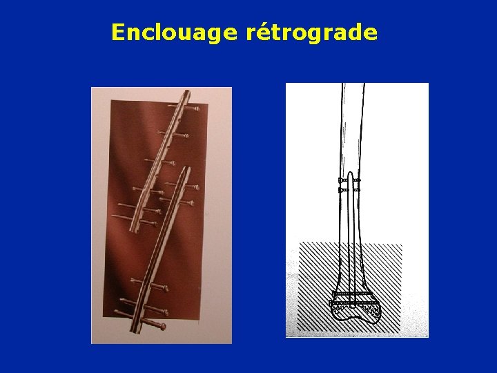 Enclouage rétrograde 