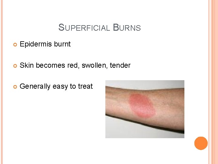 SUPERFICIAL BURNS Epidermis burnt Skin becomes red, swollen, tender Generally easy to treat 