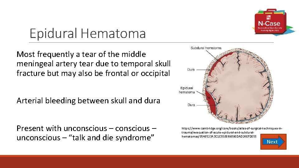 Epidural Hematoma Most frequently a tear of the middle meningeal artery tear due to