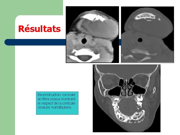 Résultats Reconstruction coronale en filtre osseux montrant le respect de la corticale osseuse mandibulaire.