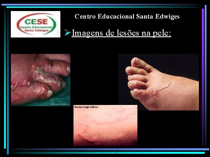 Centro Educacional Santa Edwiges ØImagens de lesões na pele: 
