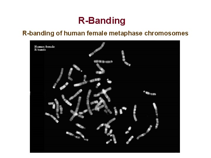 R-Banding R-banding of human female metaphase chromosomes 