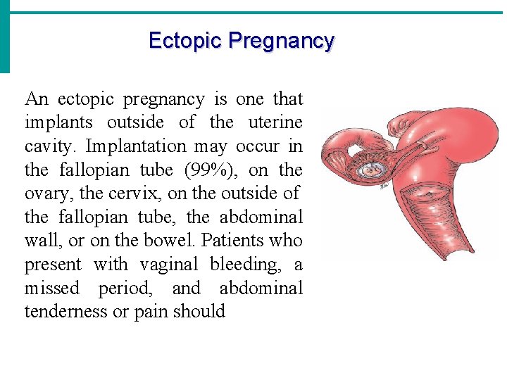 Ectopic Pregnancy An ectopic pregnancy is one that implants outside of the uterine cavity.