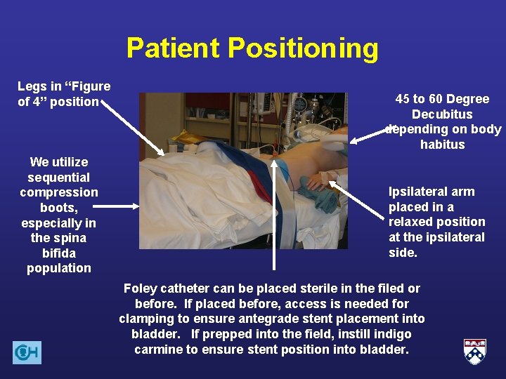 Patient Positioning Legs in “Figure of 4” position We utilize sequential compression boots, especially