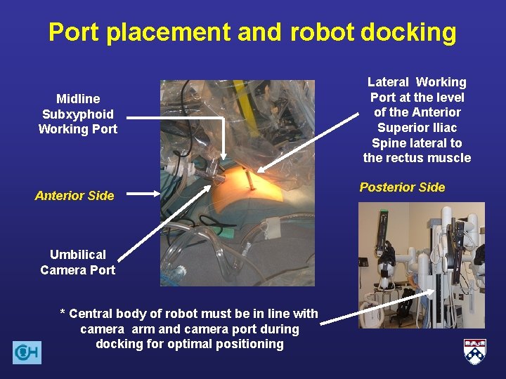 Port placement and robot docking Midline Subxyphoid Working Port Anterior Side Umbilical Camera Port